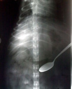 X-Ray of the Stomach of a Person With Pica Behavior