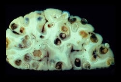 Neurocysticercosis - Tapeworm Cysts in the Brain 